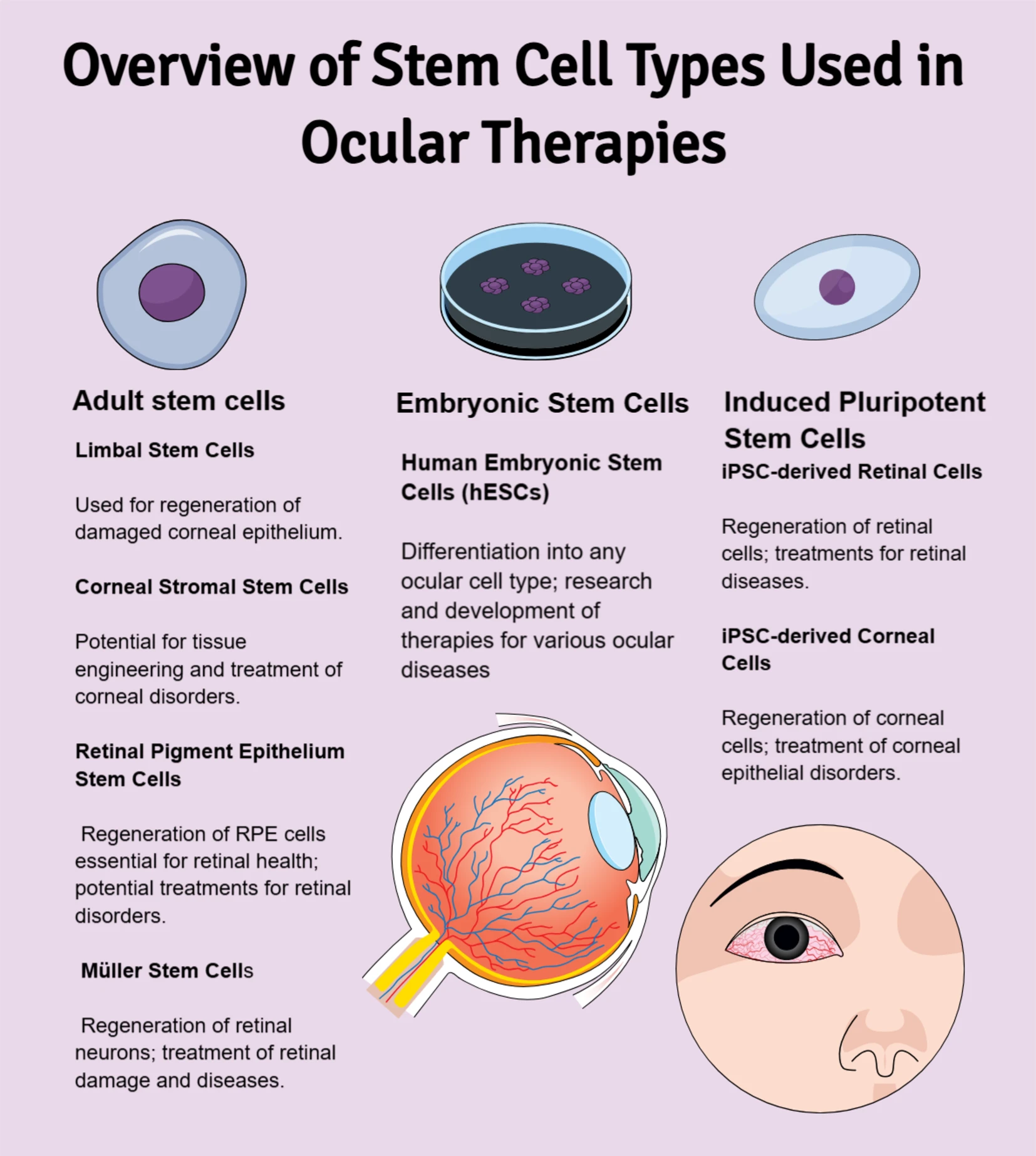 圖1:用于眼部治療的不同干細胞類型包括成體細胞、胚胎細胞和iPSC衍生細胞。這些細胞有助于視網(wǎng)膜和角膜再生,并具有潛在的治療應用。