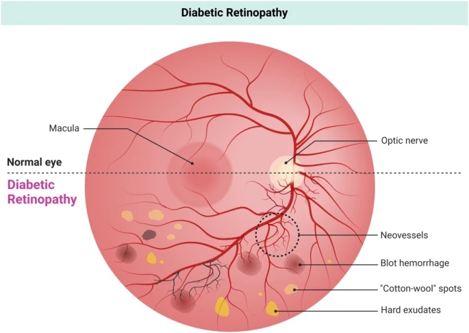 圖7:糖尿病視網(wǎng)膜病變圖示,顯示視網(wǎng)膜異常,例如新生血管、點狀出血、棉絨斑和硬性滲出物。對比圖突顯了正常視網(wǎng)膜與糖尿病引起的血管并發(fā)癥之間的差異。