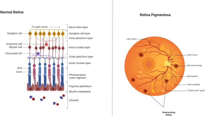 圖6:正常視網(wǎng)膜與受視網(wǎng)膜色素變性影響的視網(wǎng)膜的比較。 圖6:正常視網(wǎng)膜與受視網(wǎng)膜色素變性影響的視網(wǎng)膜的比較。