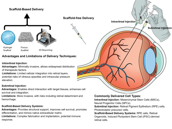 圖4:用于眼部治療的干細胞遞送技術(shù)包括無支架系統(tǒng)和基于支架的系統(tǒng)。玻璃體內(nèi)注射和視網(wǎng)膜下注射等方法在療效、安全性和整合性方面各有不同。