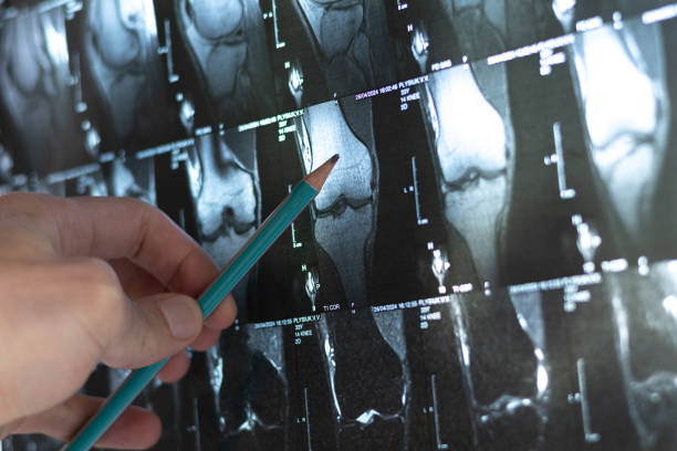 4種細胞療法運用免疫調節和再生機制為治療骨科疾病開辟了新方向 4種細胞療法運用免疫調節和再生機制為治療骨科疾病開辟了新方向