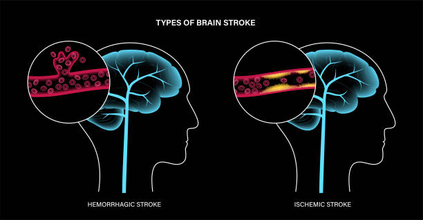 從癱瘓到復??！神經干細胞療法5大機制如何促進中風后的大腦修復？