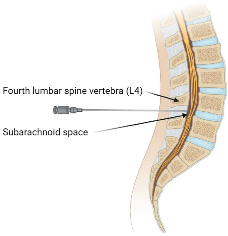 鞘內細胞輸注 鞘內細胞輸注