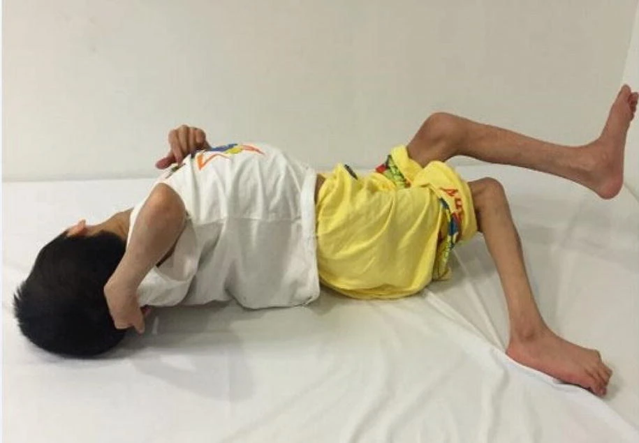 痙攣性腦癱 痙攣性腦癱