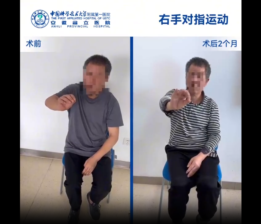 國內誘導多能干細胞療法新突破:首例早發型帕金森病成功給藥,當天即可行走 國內誘導多能干細胞療法新突破:首例早發型帕金森病成功給藥,當天即可行走