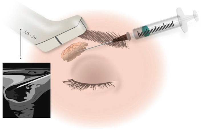 圖1:在超聲引導下向淚腺注射藥物。 圖1:在超聲引導下向淚腺注射藥物。