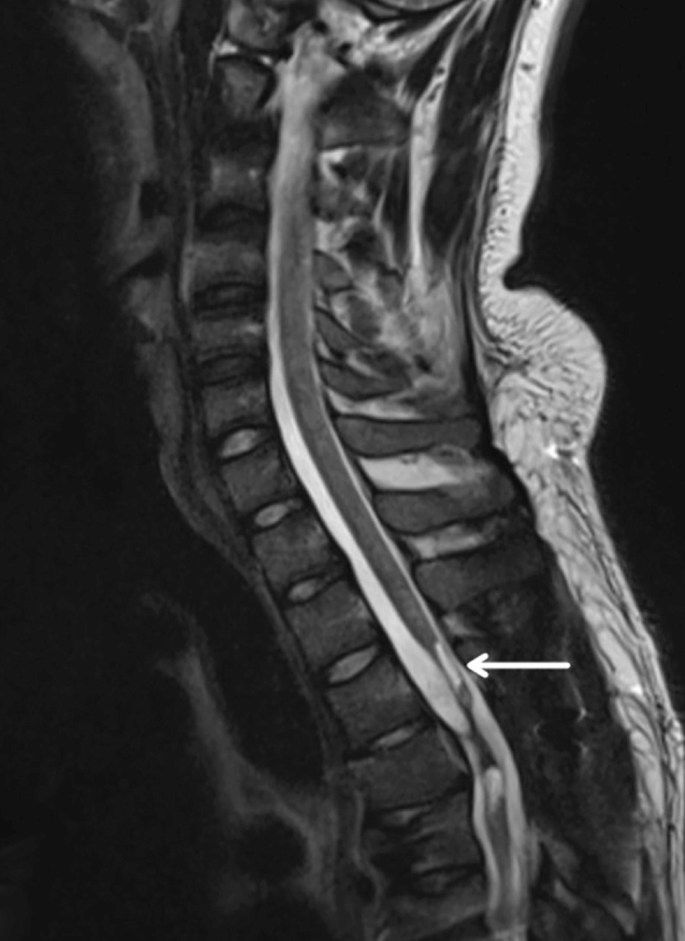 圖2：X射線圖像顯示慢性期脊髓損傷，通常以囊腫形成為特征，如白色箭頭所示
