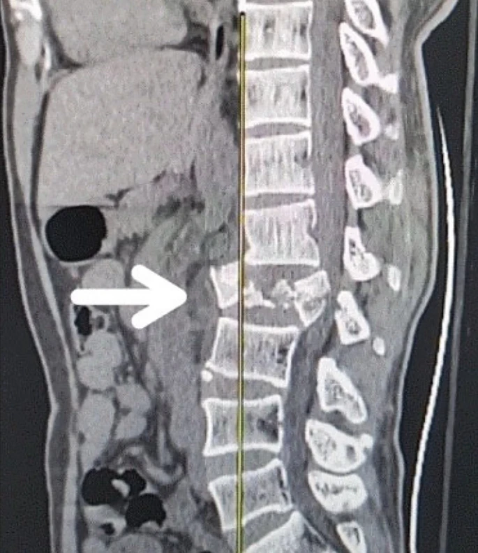 圖1：X射線圖像顯示脊髓損傷，椎骨骨折和移位，如白色箭頭所示