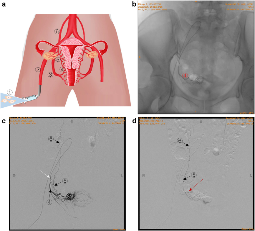 經(jīng)卵巢動(dòng)脈精準(zhǔn)輸注hAEC 經(jīng)卵巢動(dòng)脈精準(zhǔn)輸注hAEC