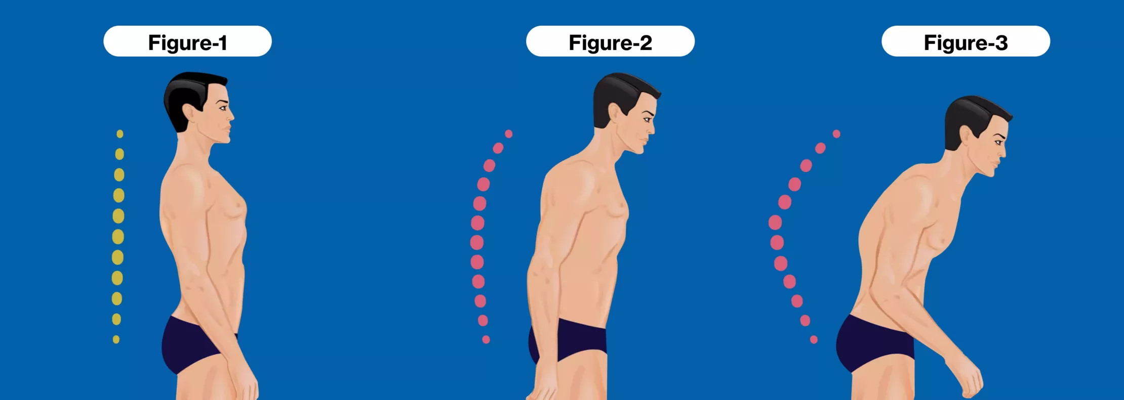2025強(qiáng)直性脊柱炎治療指南：5種最新治療方法的臨床突破