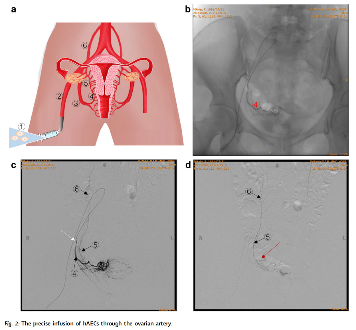 卵巢早衰臨床試驗 卵巢早衰臨床試驗