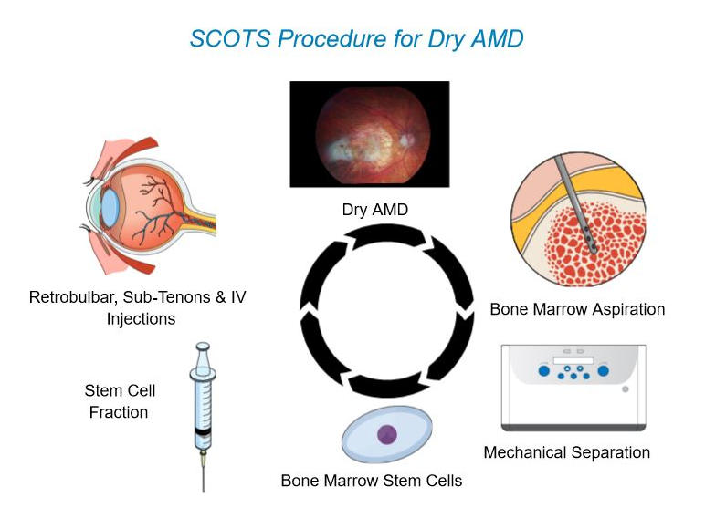 干細胞治療年齡相關黃斑變性