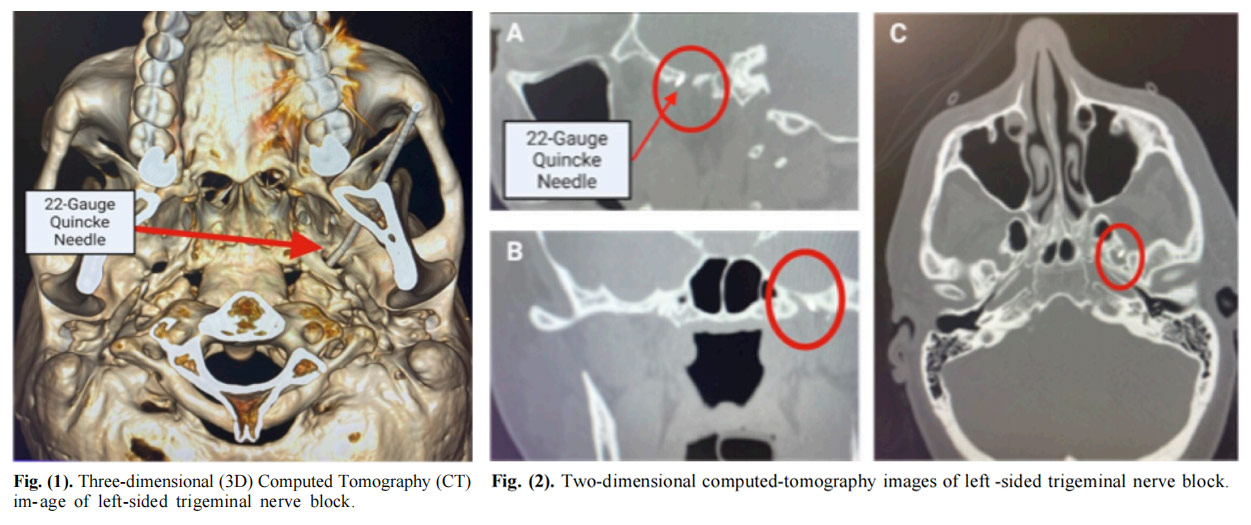 三叉神經(jīng)痛臨床試驗