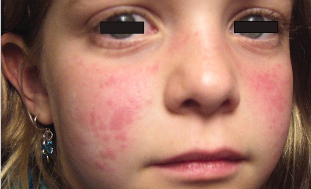 干細(xì)胞移植