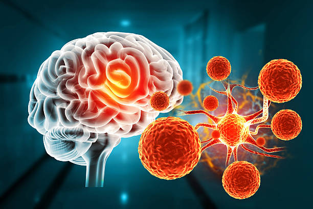 干細胞治療帕金森病取得新進展！II期臨床證實：三次輸注，安全且運動功能得到改善