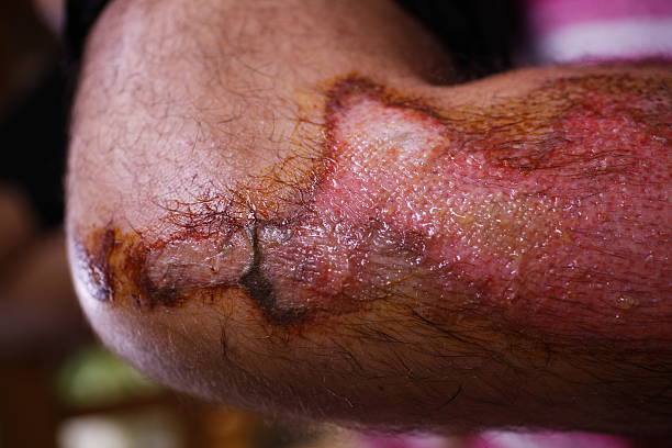 干細胞修復面部深度燒傷:1例患者術后面部基本恢復正常 | 成功案例 干細胞修復面部深度燒傷:1例患者術后面部基本恢復正常 | 成功案例