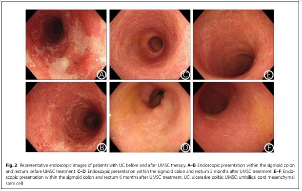 圖2：潰瘍性結腸炎患者接受UMSC治療前后內鏡檢查的典型圖像