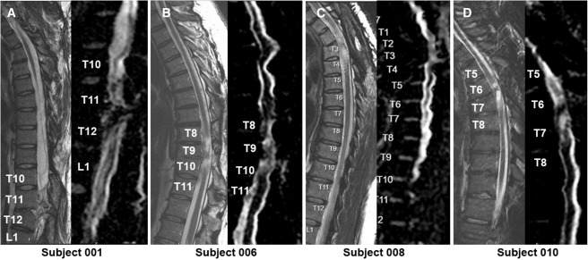 MRI頸胸T2矢狀圖和AvDC矢狀圖 MRI頸胸T2矢狀圖和AvDC矢狀圖