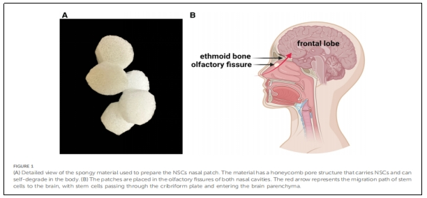 圖1:用于制備N(xiāo)SCs鼻貼片的海綿狀材料的詳細(xì)視圖。 圖1:用于制備N(xiāo)SCs鼻貼片的海綿狀材料的詳細(xì)視圖。