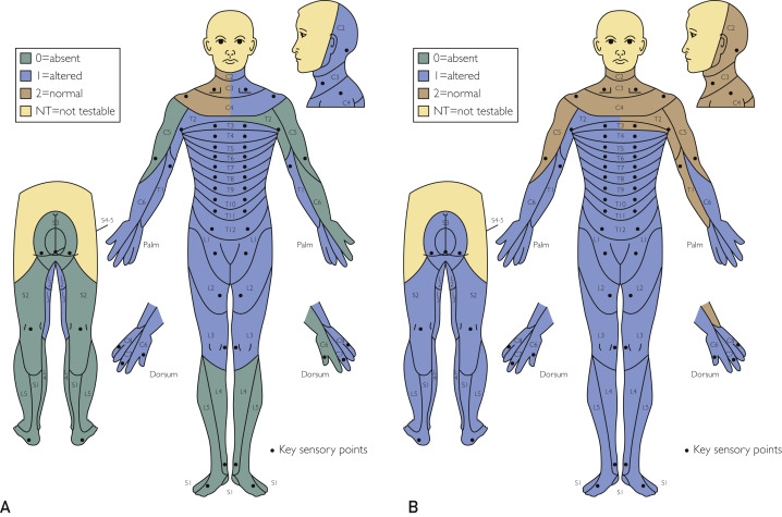 圖2：根據(jù)脊髓損傷神經(jīng)學(xué)分類國際標(biāo)準(zhǔn)，在基線（A）和 18 個月隨訪（B）時形成的皮節(jié)感覺評分。