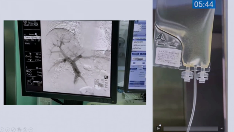 殷浩教授展示了干細胞療法的治療過程 殷浩教授展示了干細胞療法的治療過程