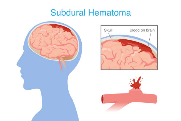 神經(jīng)干細(xì)胞移植治療腦出血的系統(tǒng)評價：NSC來源、輸送途徑、治療機(jī)制和早期臨床試驗(yàn)