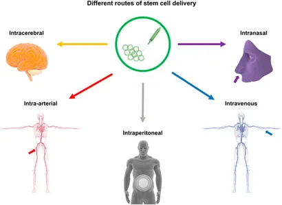 干細胞移植途徑:該圖展示了用于中風治療的干細胞輸送途徑,包括腦內(立體定向注射)、血管內(靜脈/動脈)、腹腔內、腦室內、靜脈內、鼻內和鞘內注射方法。 干細胞移植途徑:該圖展示了用于中風治療的干細胞輸送途徑,包括腦內(立體定向注射)、血管內(靜脈/動脈)、腹腔內、腦室內、靜脈內、鼻內和鞘內注射方法。