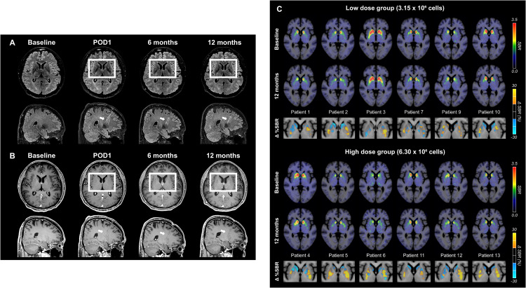 圖6:代表性腦部MRI圖像以及A9-DPC移植后18F -FP-CIT攝取量的個體水平變化 圖6:代表性腦部MRI圖像以及A9-DPC移植后18F -FP-CIT攝取量的個體水平變化